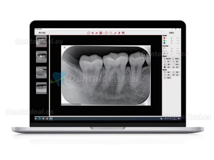 Runyes DS630 Esc&aacute;ner PSP Dental de Placas de Imagen Digital para Rayos X